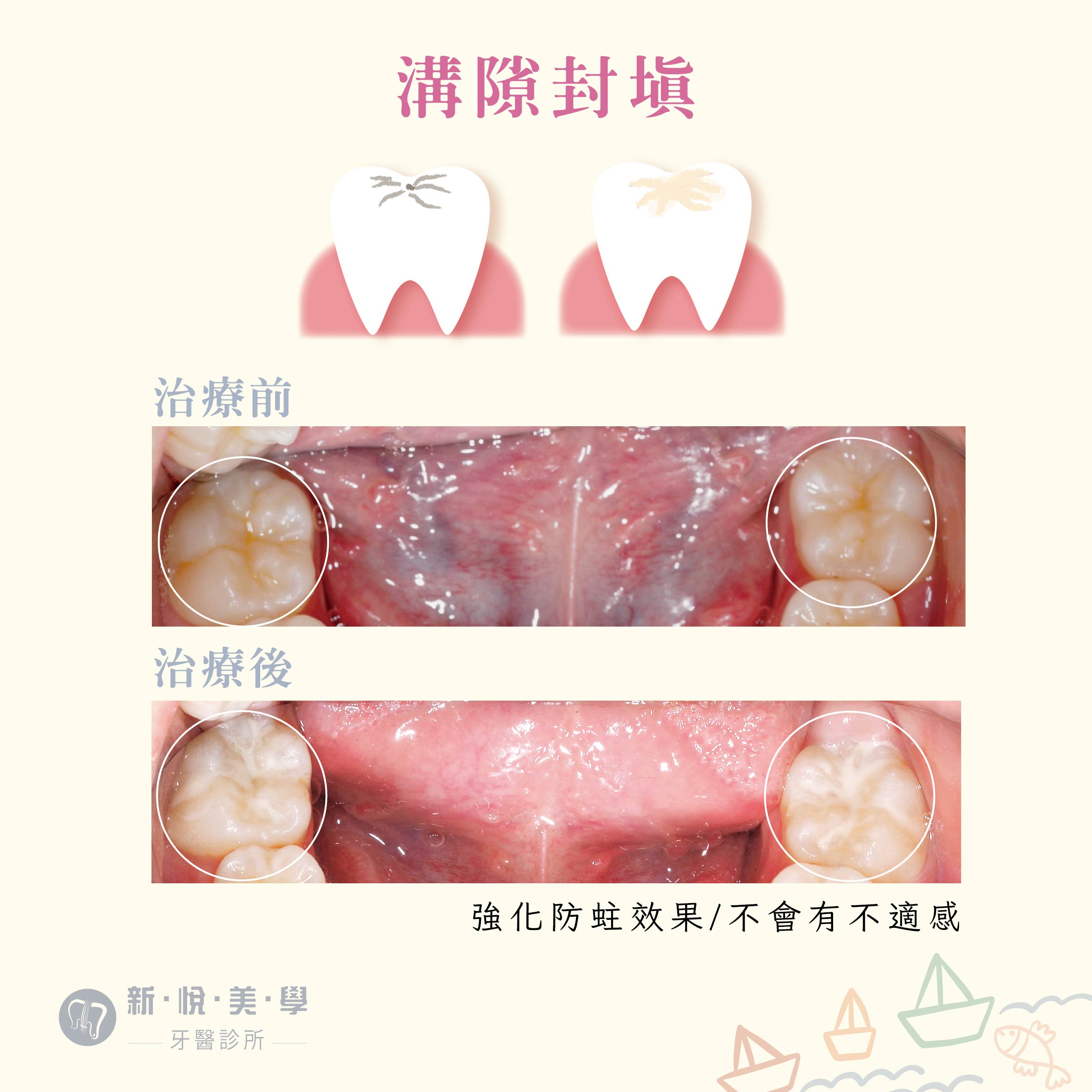 [新悅美學牙醫案例]  我們家寶貝有蛀牙怎麼辦?的第2張圖片